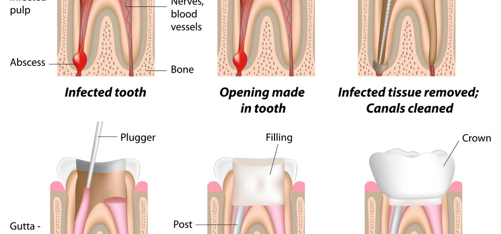 Root Canal Therapy