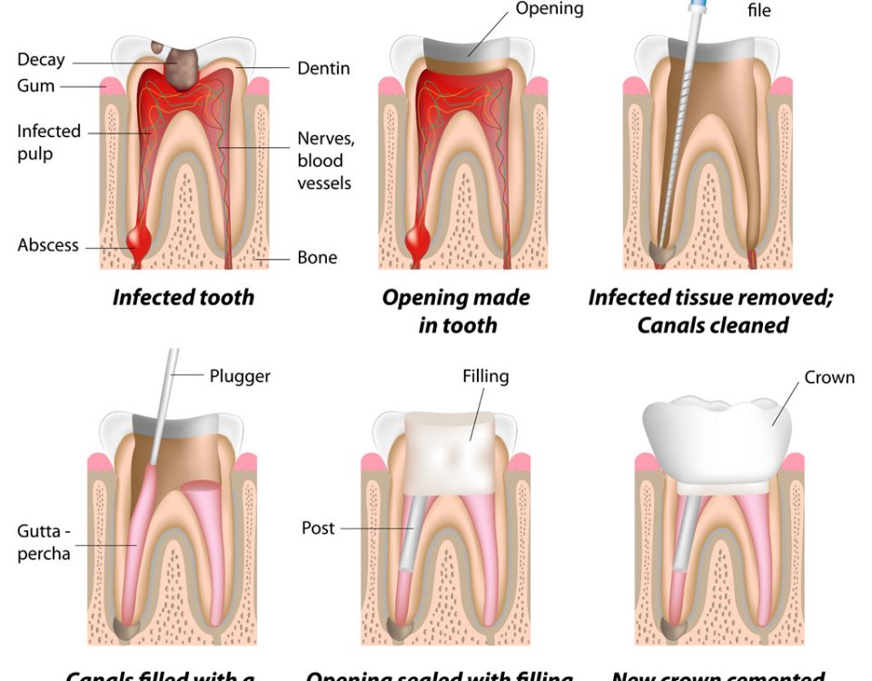 Root Canal Therapy