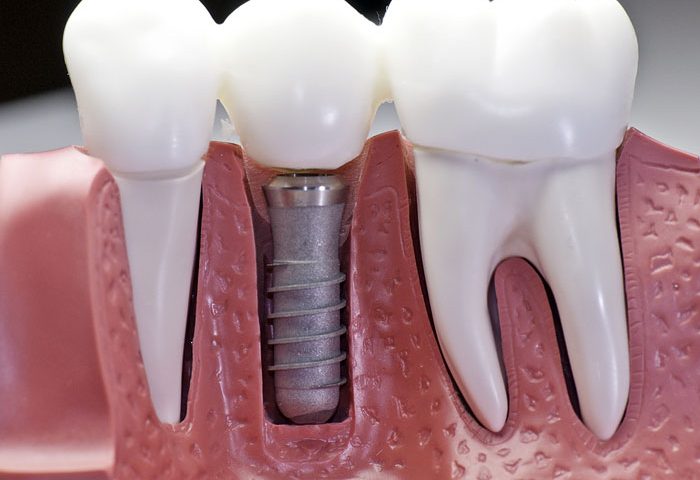 Dental Implants